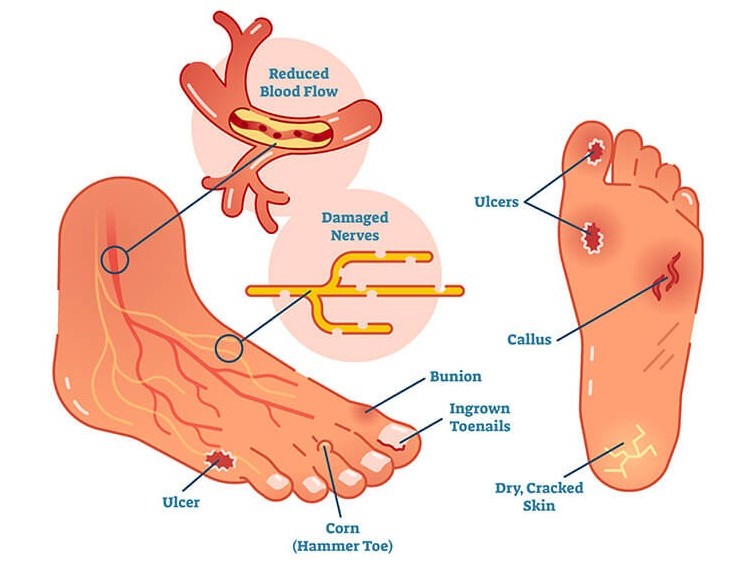 Link Between Chronic Wounds and Diabetes: What You Need to Know